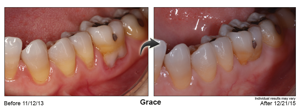 fix gum recession Palm Desert CA