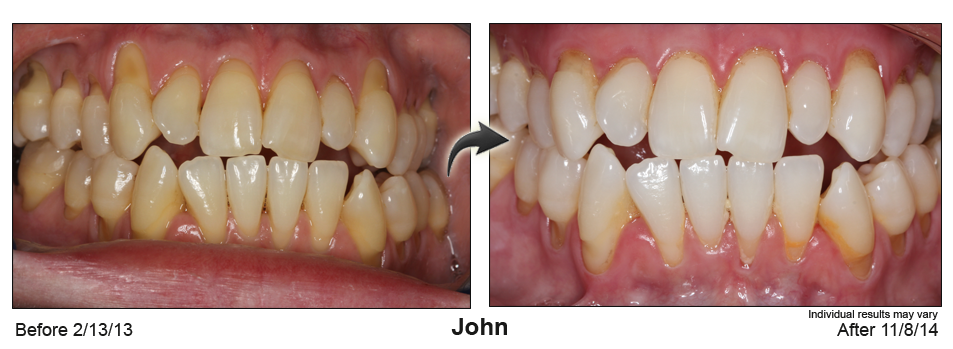 Palm Desert CA gum recession