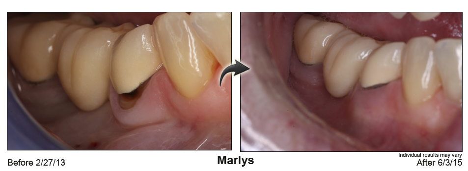 fix receding gums Palm Desert CA